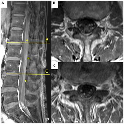 Chronic Inflammatory Demyelinating Polyneuropathy With Concurrent Membranous Nephropathy: An Anti-paranode and Podocyte Protein Antibody Study and Literature Survey